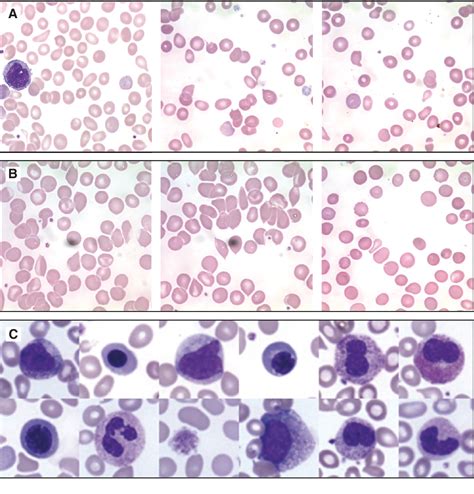 Significance of teardrop cells in peripheral blood 